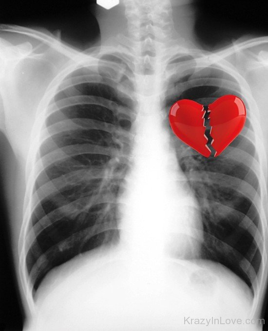 Broken Heart In Xray-tws205